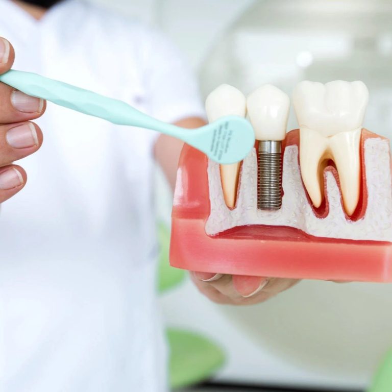BenefitsofDentalImplants