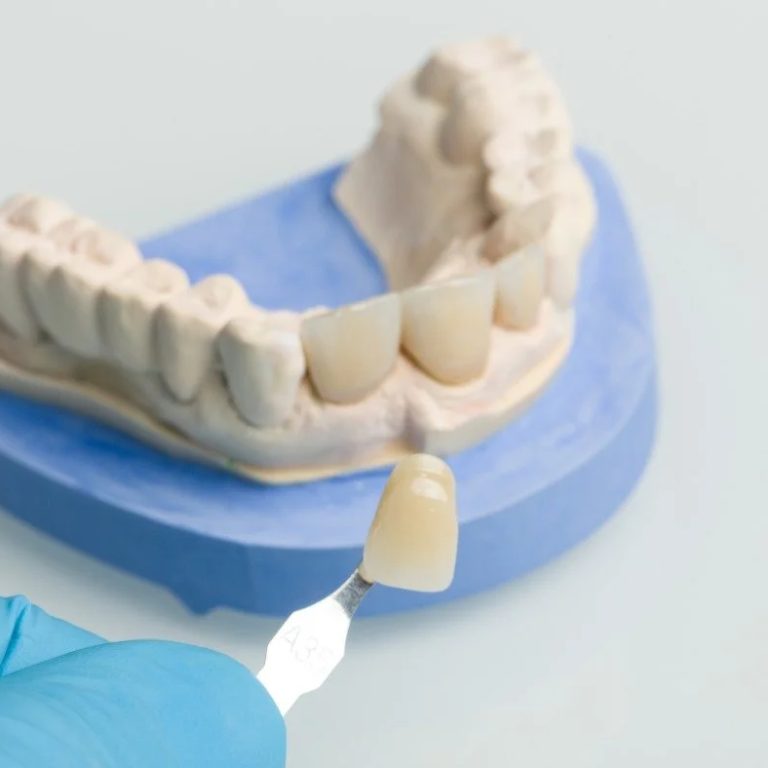 DentalCrownCostinToronto