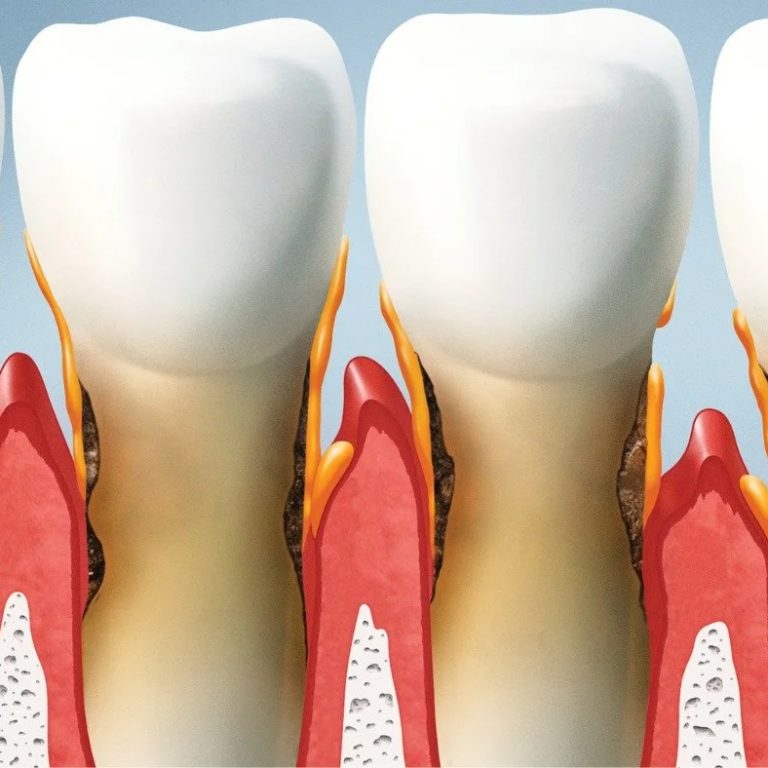 RecedingGumsStages