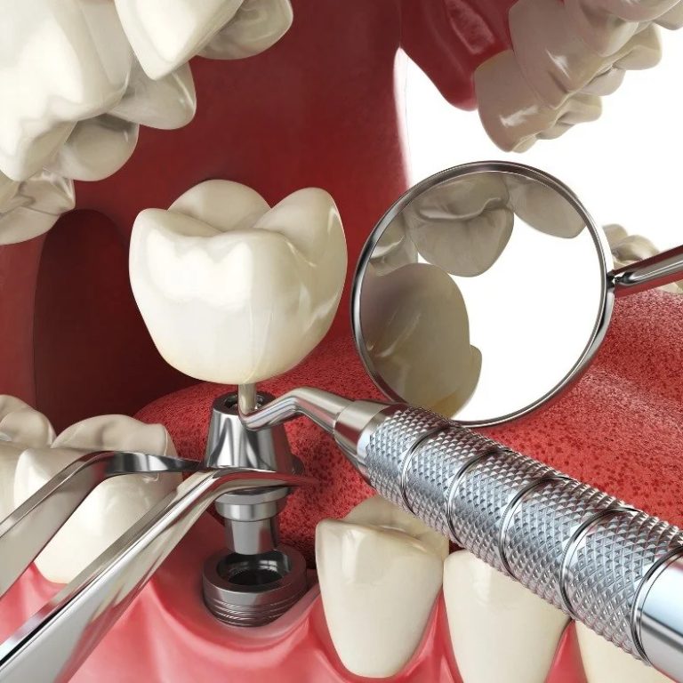 Single-ToothDenture