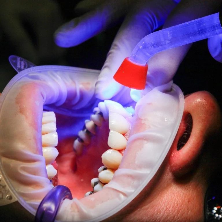 TeethFillingCost