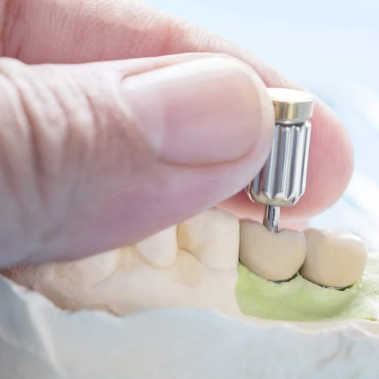 dental-implants-in-toronto