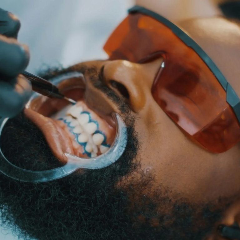 laser-teeth-whitening-min
