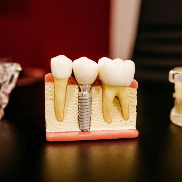 worst-part-of-dental-implant-cover